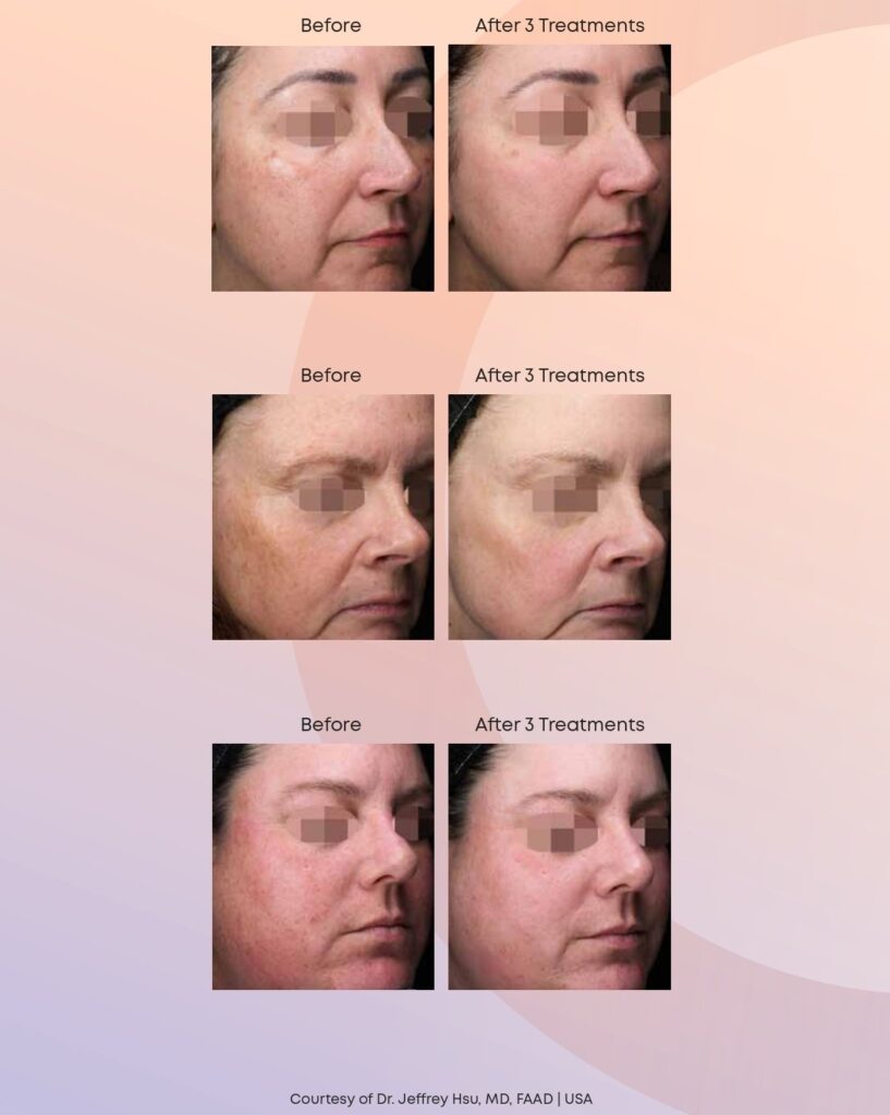 Before and After Treatments with Alma Harmony